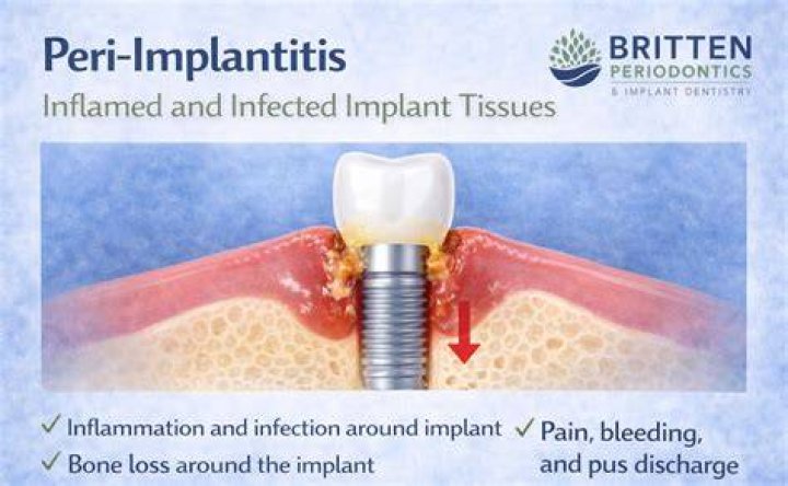 How Common Is Peri Implantitis? (Solution)