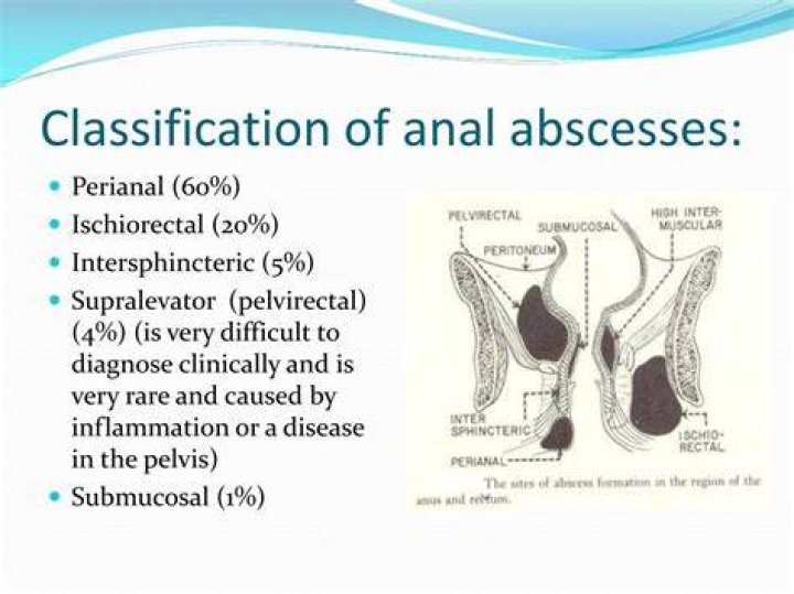 How Long Do Peri-anal Abscesses Drain?
