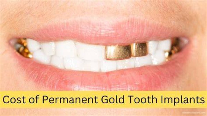 Permanent Gold Teeth Cost