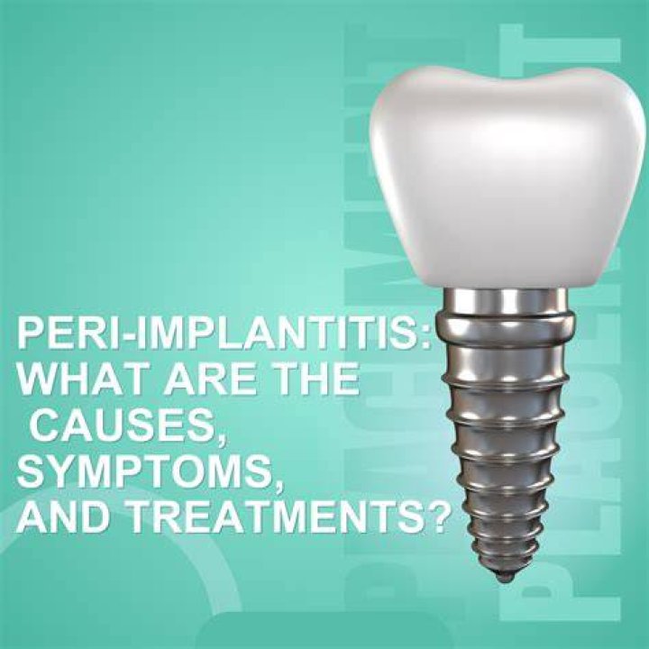What Causes Peri Implantitis? (Correct answer)