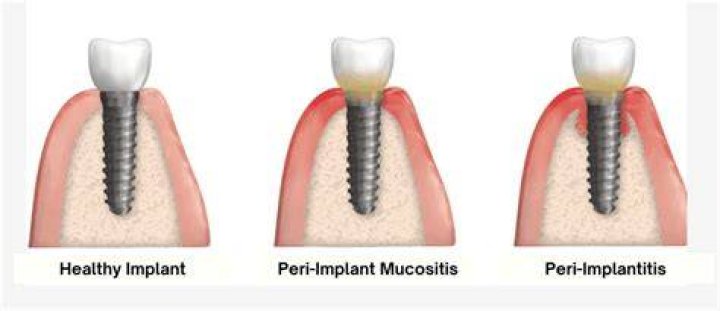 What Causes Peri-implantitis? (Solved)
