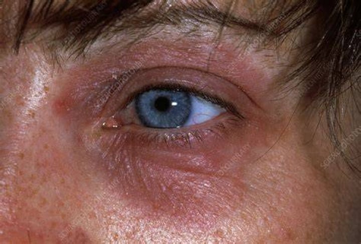 What Causes Peri Orbital Dermatitis? (Solution)