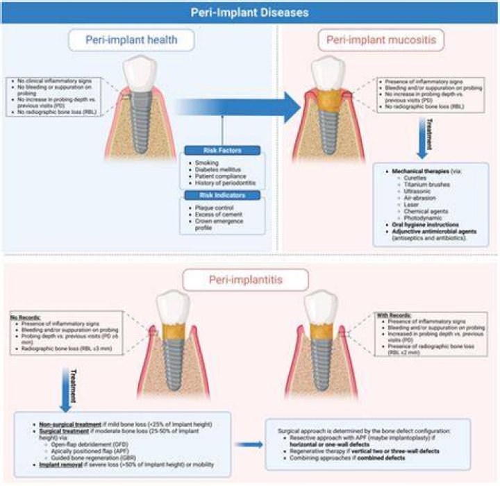 What Does Peri Implant Mean? (Question)