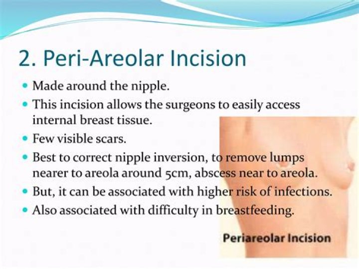 What Is Peri-areolar Surgery?