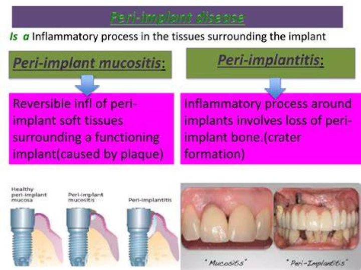 What Is Peri Implant Bone? (Solved)