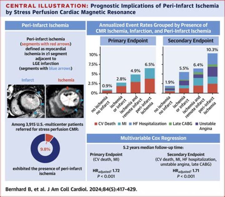 What Is Peri Infarct Ischemia? (Solution found)