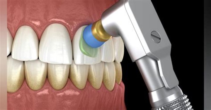 What is selective polishing?