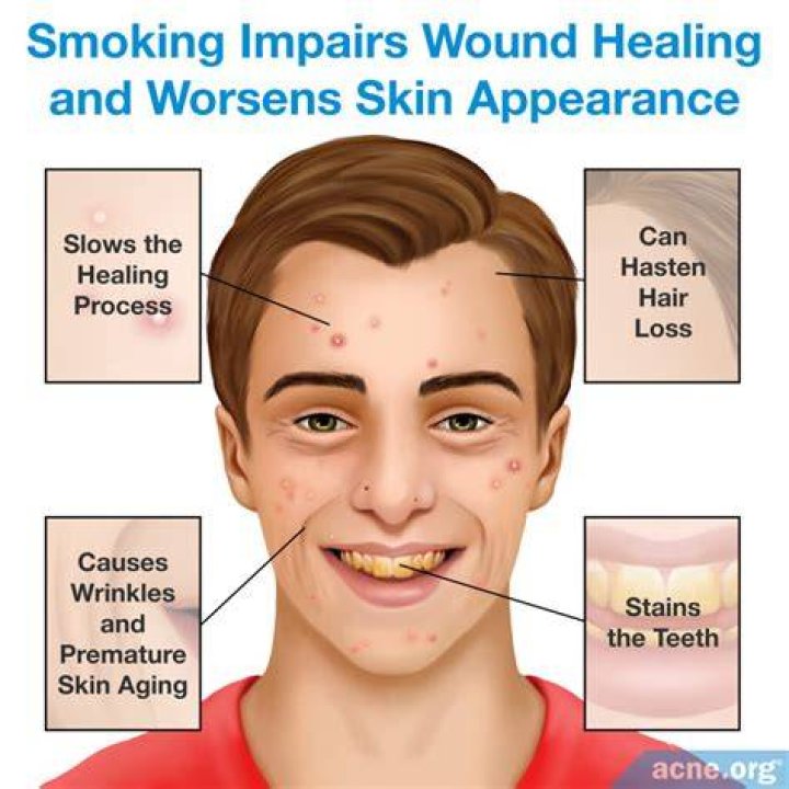 Why Does Smoking Cause Peri Implantitus? (Solution found)